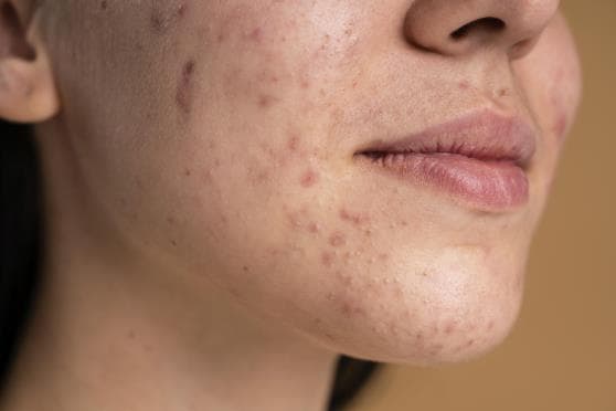 Acne Scars